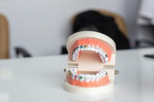 ile-trwa-zrobienie-aparatu-ortodontycznego