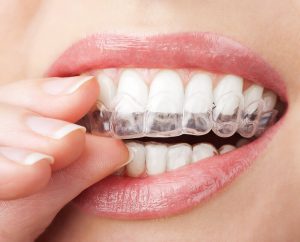 Czy wybielanie zębów niszczy szkliwo?