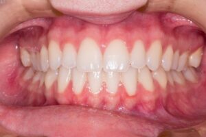 Bruksizm objawy i skutki. Leczenie zgrzytania zębami